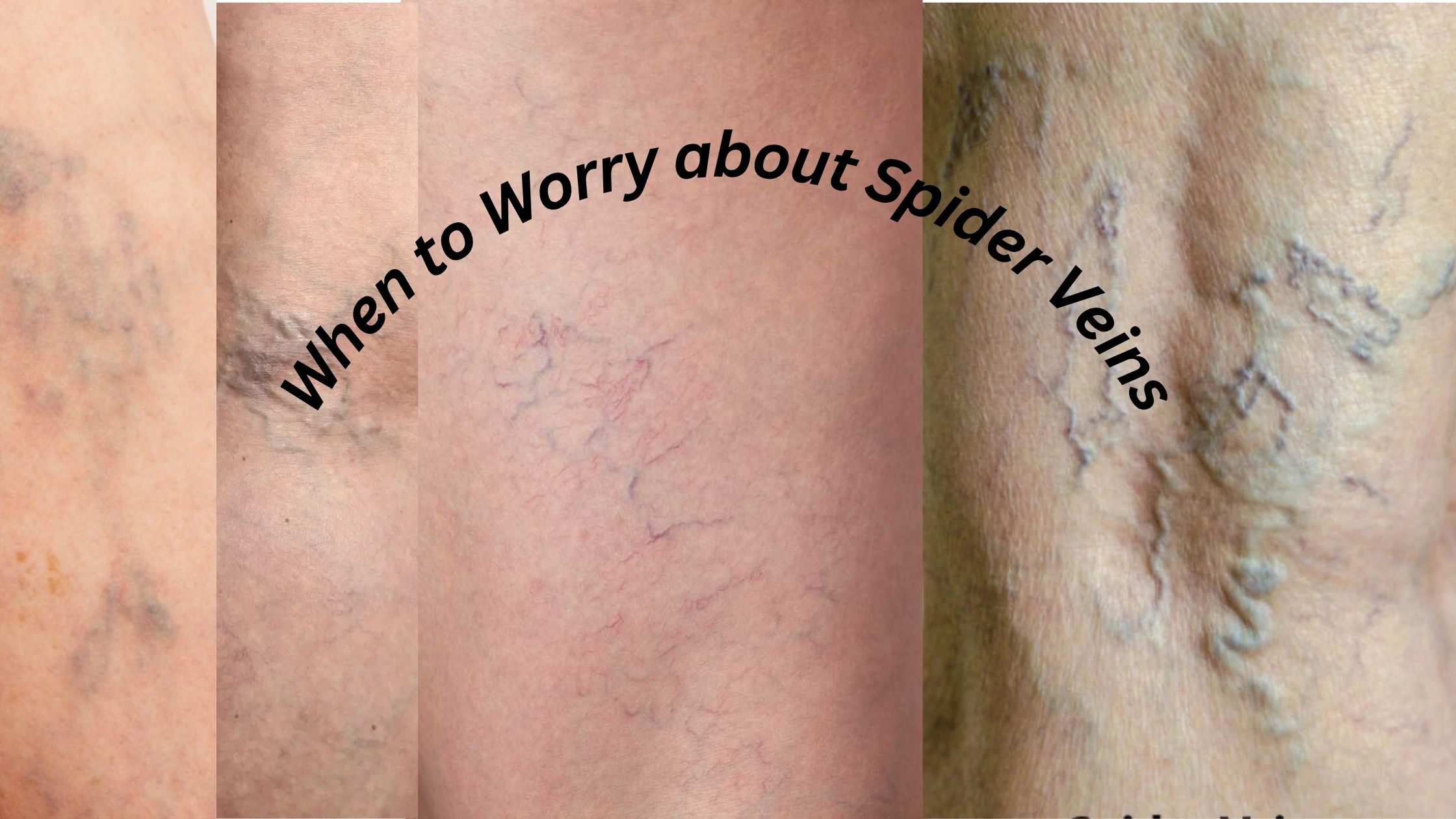 When to Worry about Spider Veins