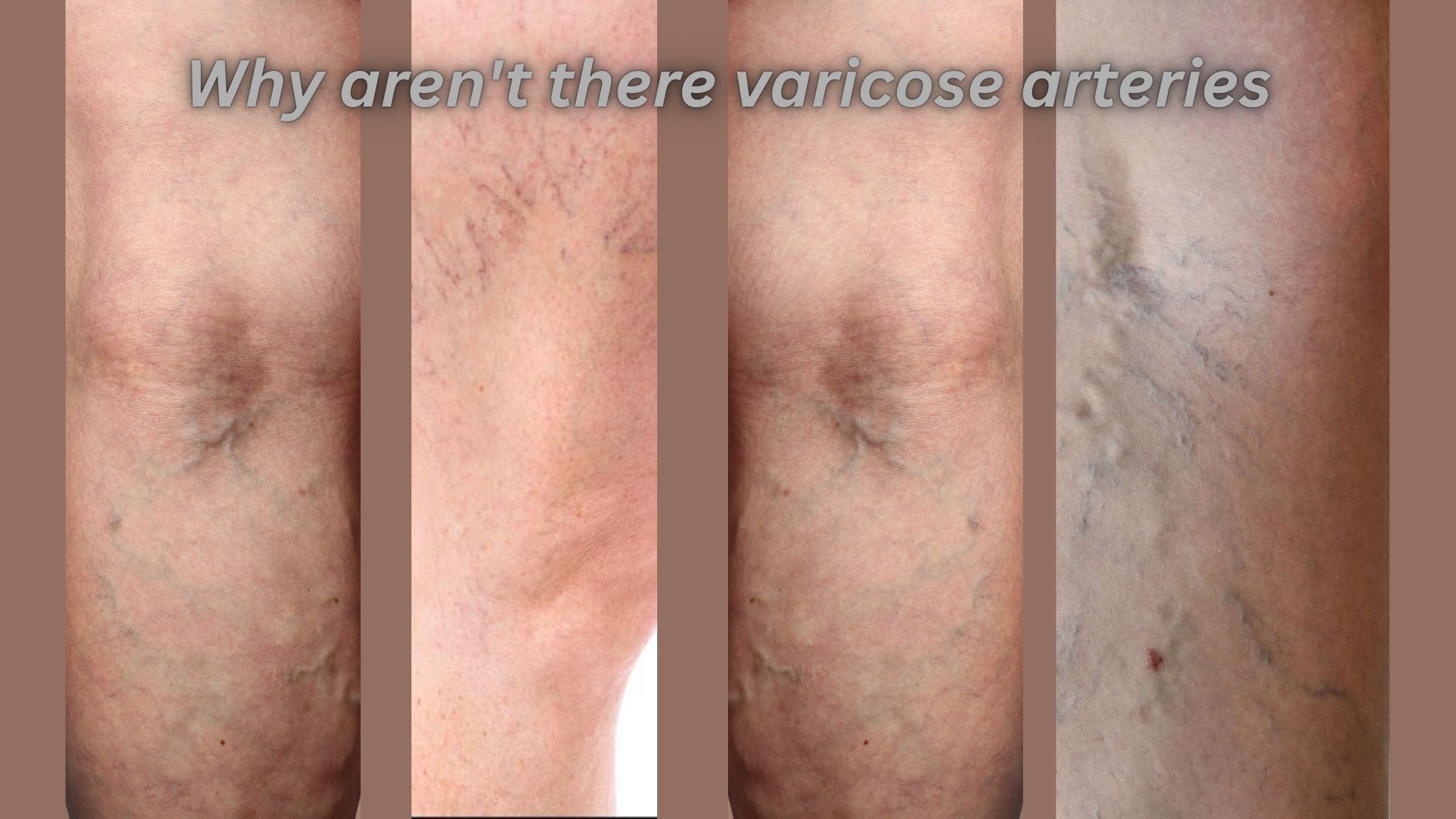 Why aren't there varicose arteries